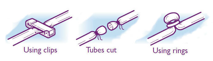Female Sterilisation Tubal Occlusion Diagram