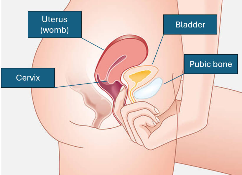 Feeling for the pubic bone